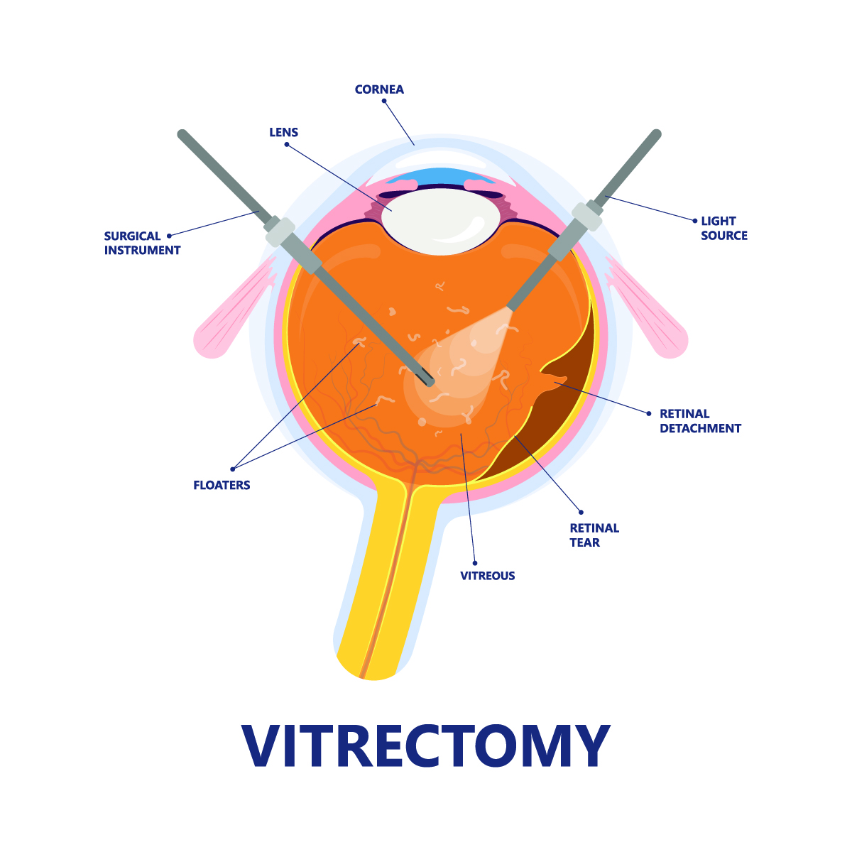 Advanced Retina Surgery