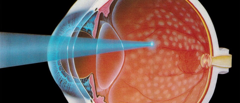 Laser Treatment